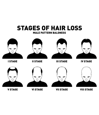 How to stop balding naturally increase