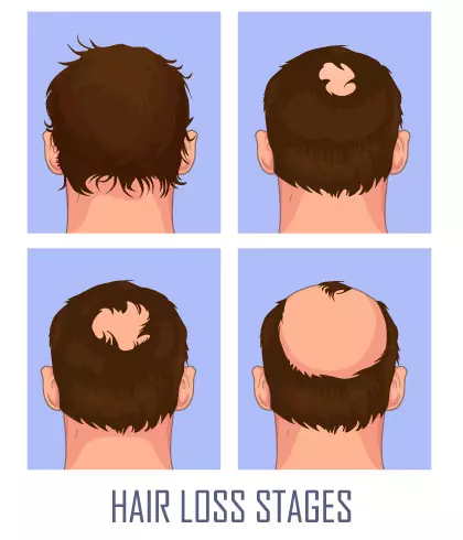 Know what it's like to have alopecia
