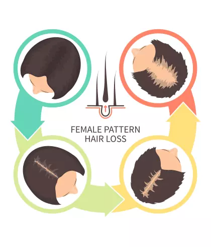 Hairstyles for female pattern hair loss