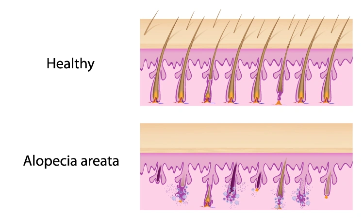 Alopecia Areata cause Itching Treatment in Homeopathy