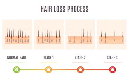 Monsoon Hair Fall | Hair Fall in Rainy Season: How to Stop? | MFine -  YouTube