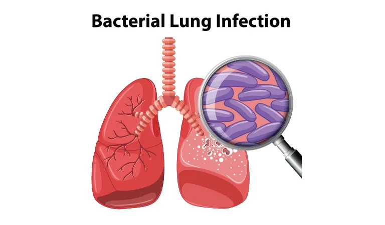 Homeopathy for a lung infection