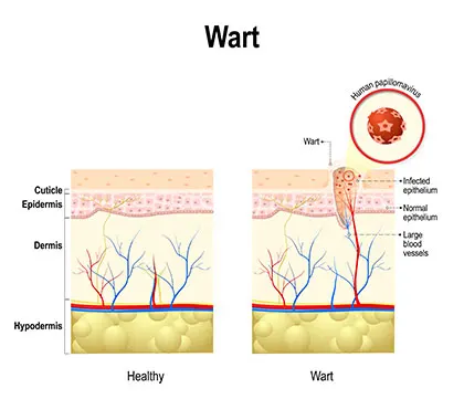 wart