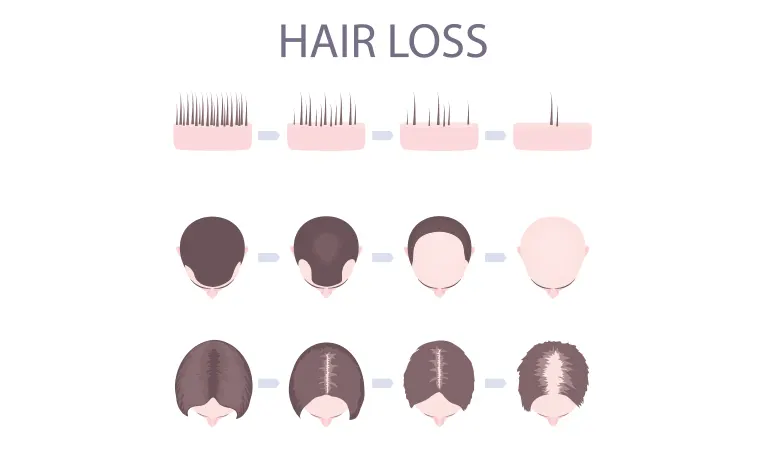 How does hair fall in men starts?