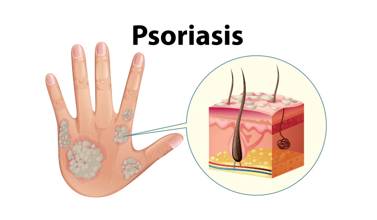 How homeopathy provides long-term relief from psoriasis?