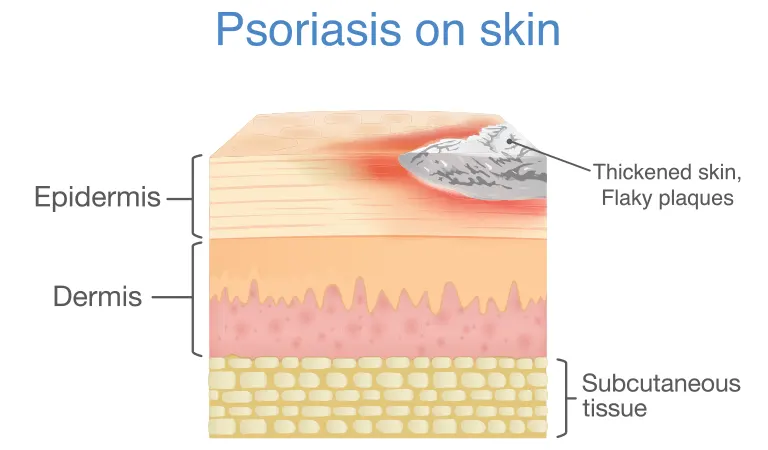 How to care for psoriasis symptoms when the season changes?