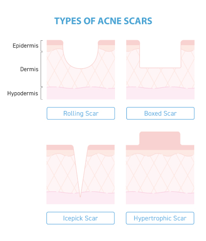 How to reduce acne scars?