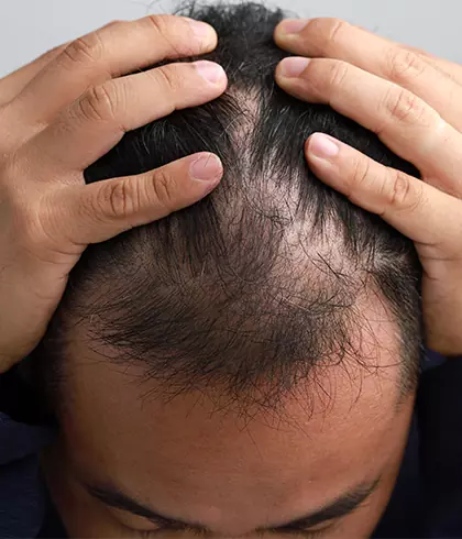 Is castor oil good for alopecia areata? - Dr Batra's®