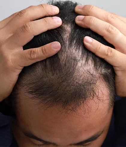 Is castor oil good for alopecia areata? - Dr Batra's® Is castor oil good for alopecia areata? - Dr Batra's®