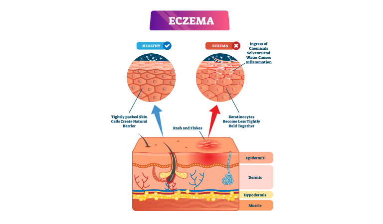 Is DermaHeal good for eczema?