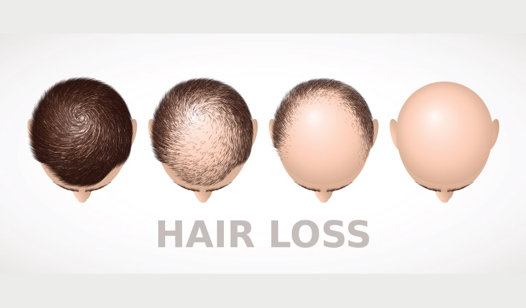 Is new hair growth possible with non-surgical Homeopathic Treatment? - Dr  Batra's®