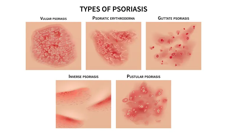 Is psoriasis hereditary?