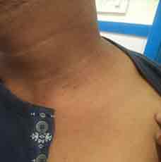 Lichen-Planus-after-outcome