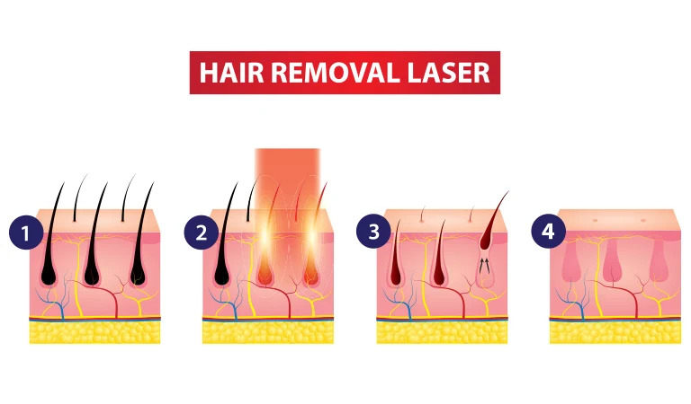 Laser Hair Removal Treatment for Male in Surat Gujarat India