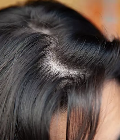 Pregnancy & hair fall in women | Dr Batra's™ Pregnancy & hair fall in women | Dr Batra's™
