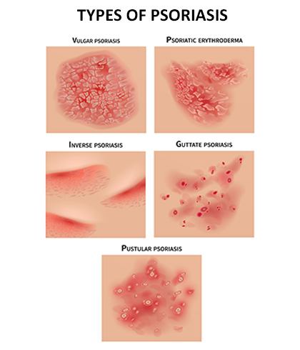 psoriasis flare up in summer