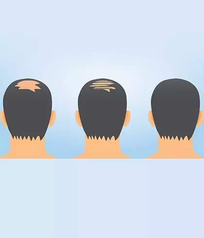 Reasons For Hair Fall In Men - Dr. Batra's®