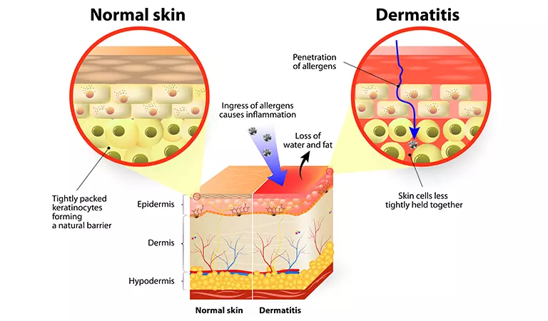 Seborrheic Dermatitis vs. Atopic Dermatitis