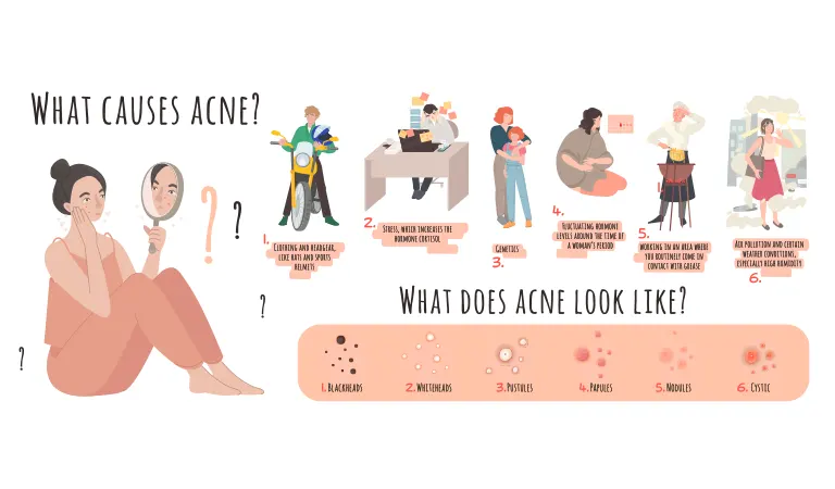 Stress acne: Symptoms & treatments