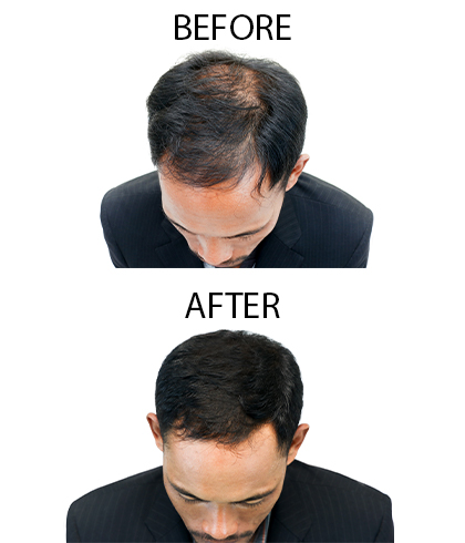 FUT Before & After Photos Patient 1028 | Rochester, Buffalo, & Syracuse, NY  | Quatela Center for Hair Restoration