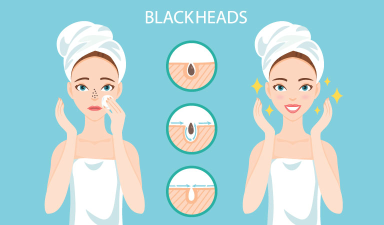 How to get rid of blackheads?