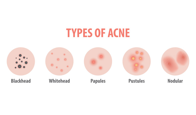 10 facts about acne