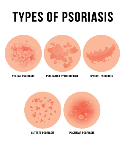 How to prevent psoriasis from recurring?
