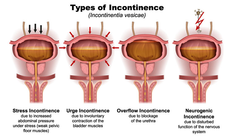 Urinary incontinence