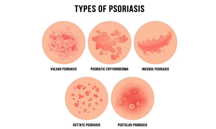 Psoriasis on hands: Causes & treatment