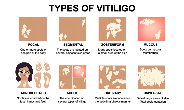 How to stop getting new vitiligo patches?