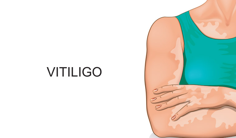Vitiligo & Anxiety