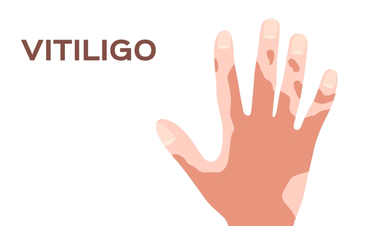 5 ways to stop vitiligo from spreading