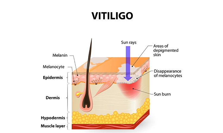 8 ways to stay motivated during vitiligo treatment