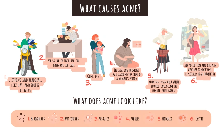 Stress acne: Symptoms & treatments