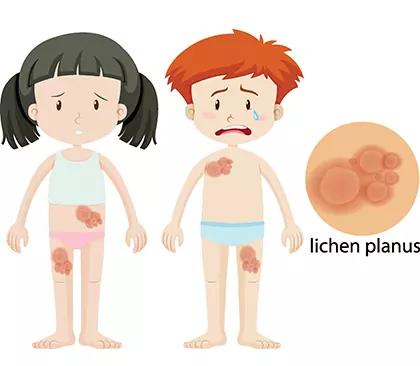 What is the onset of lichen planus?