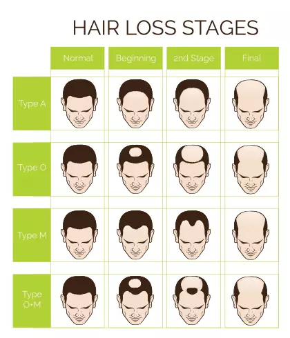 HAIRFALL IN MEN  VPlant Advanced Hair Care Clinics