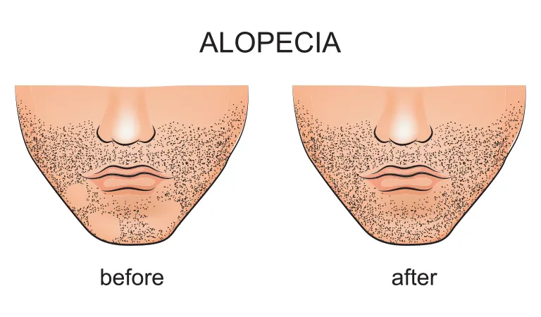 Why does alopecia areata occur?