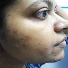 acne-before-outcome