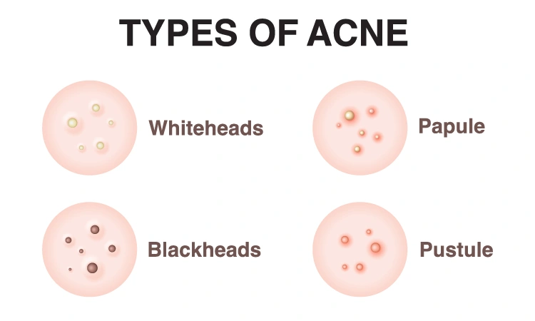 Homeopathy — Best Remedy for Acne.