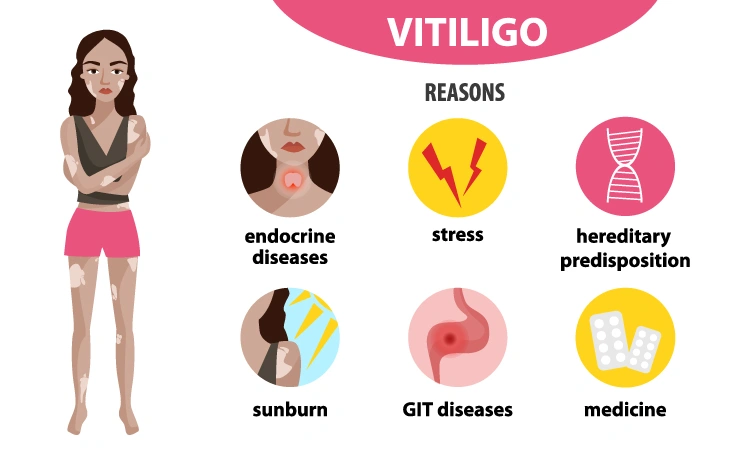 All you need to know about vitiligo