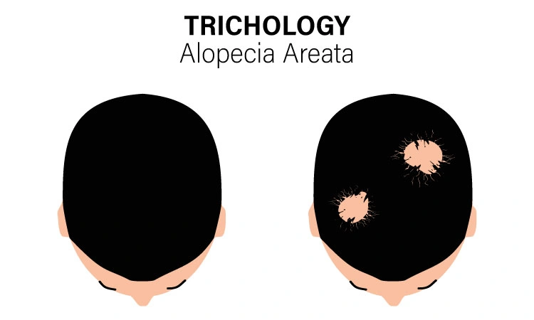 Alopecia Areata Homeopathic Treatment & Diet