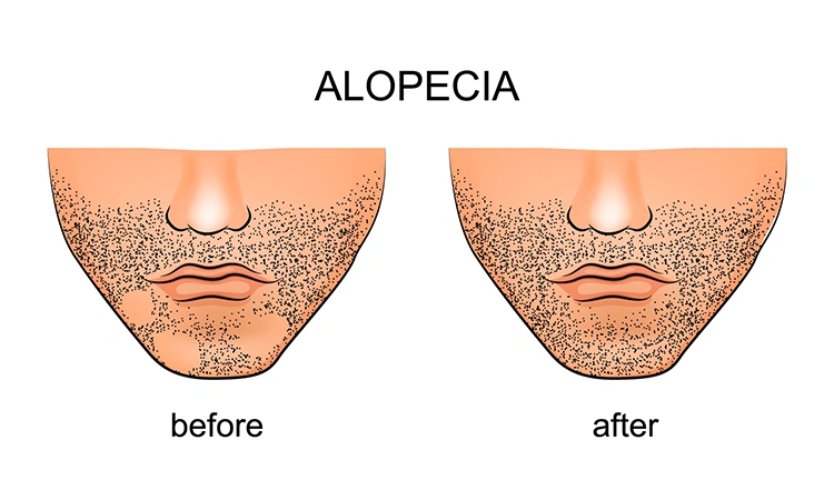 5 Helpful Tips to Manage Alopecia Areata