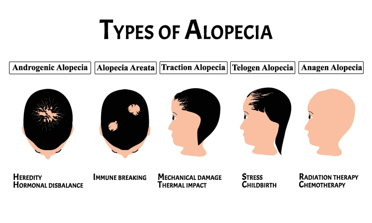 Types of Alopecia