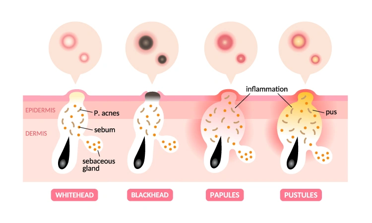 What are the characteristics of acne?