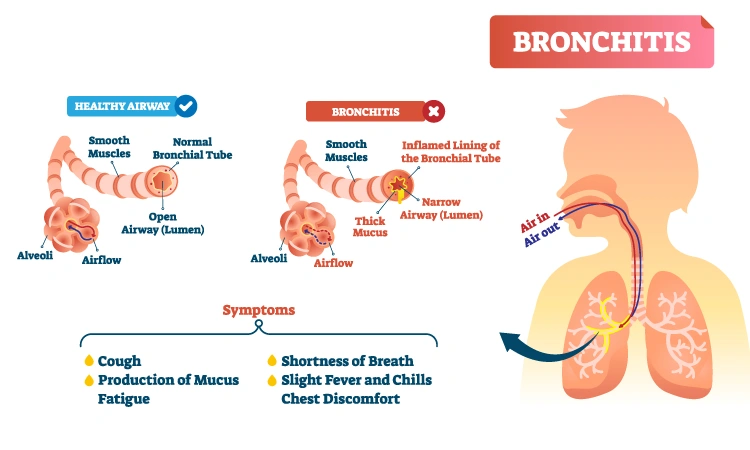 Chronic bronchitis in elderly: Causes and prevention