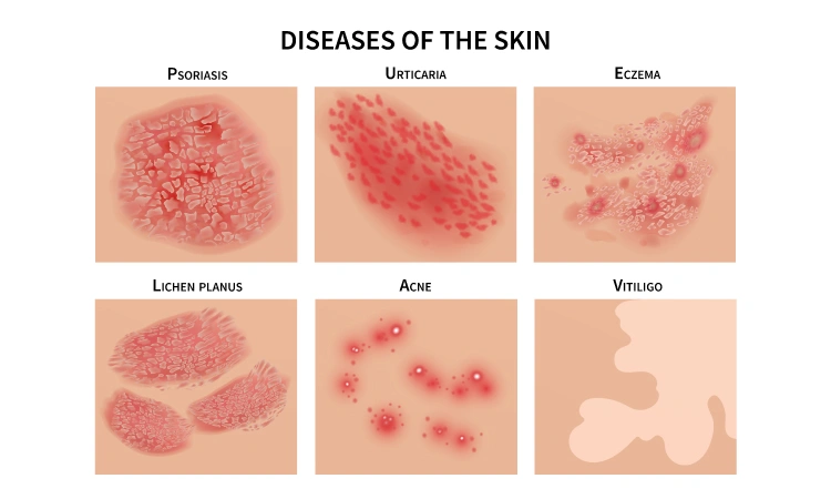 Eczema vs Psoriasis — Know the difference.