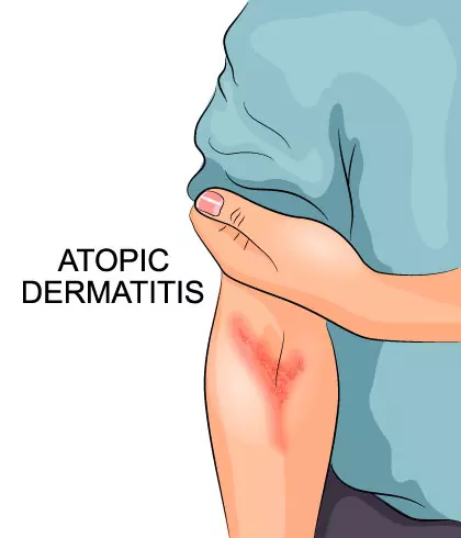 Will seborrhoeic dermatitis go away?