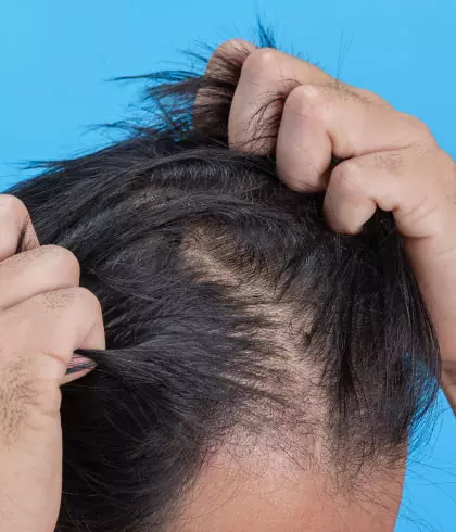Treat hair pulling disorder with homeopathy