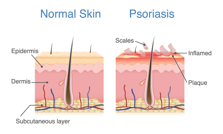 How does psoriasis affect the skin?