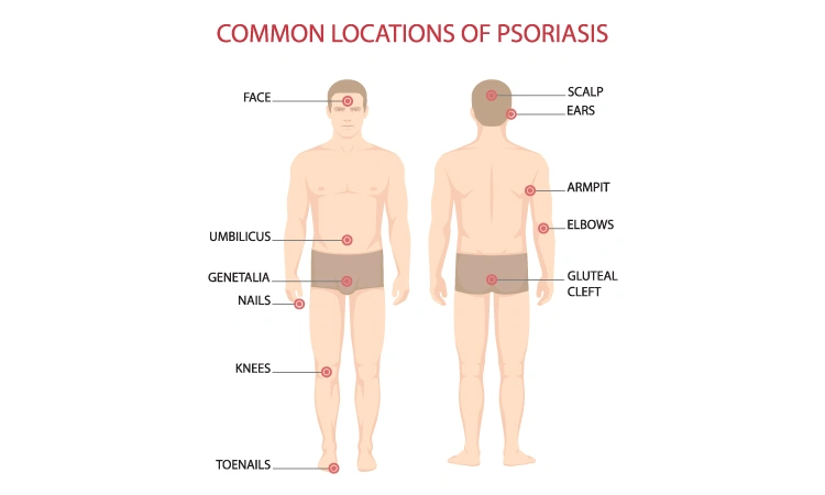 Psoriasis Triggers and Treatments